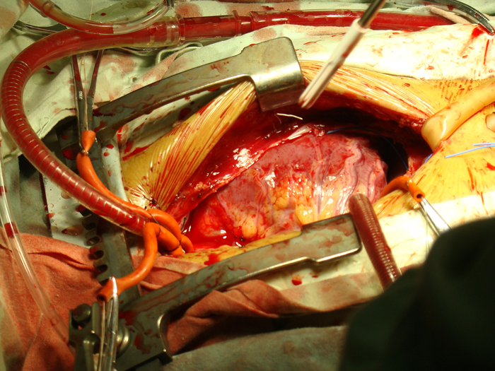li chao chao open heart surgery